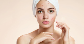 Teen Acne I Need it Gone! RomarioIen / Shutterstock.com